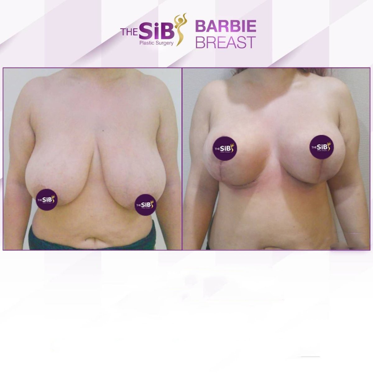 نتائج شد الثدي قبل وبعد في The SiB Plastic Surgery، تحسين شكل الثدي