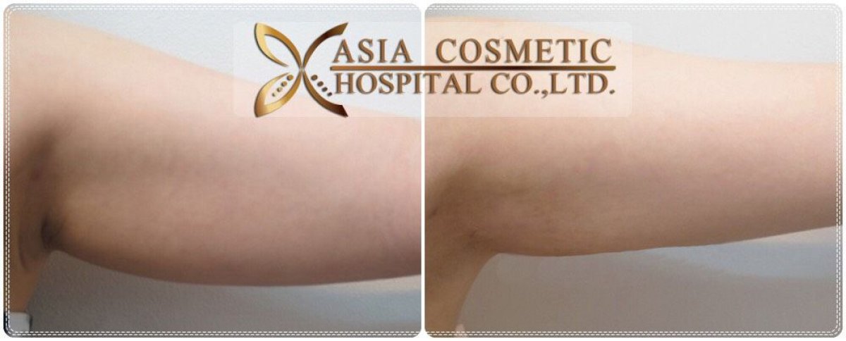 Before and after arm liposuction results at Asia Cosmetic Hospital, improved arm contour