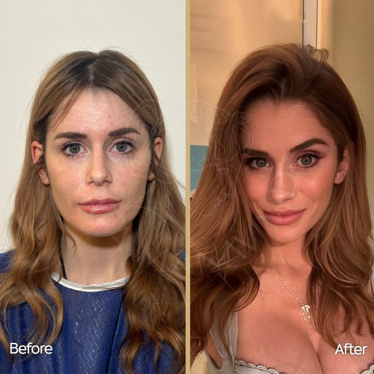 Resultados antes y después de extracción de grasa bucal en Dr. Safa Manav Clinic, mejillas más delgadas