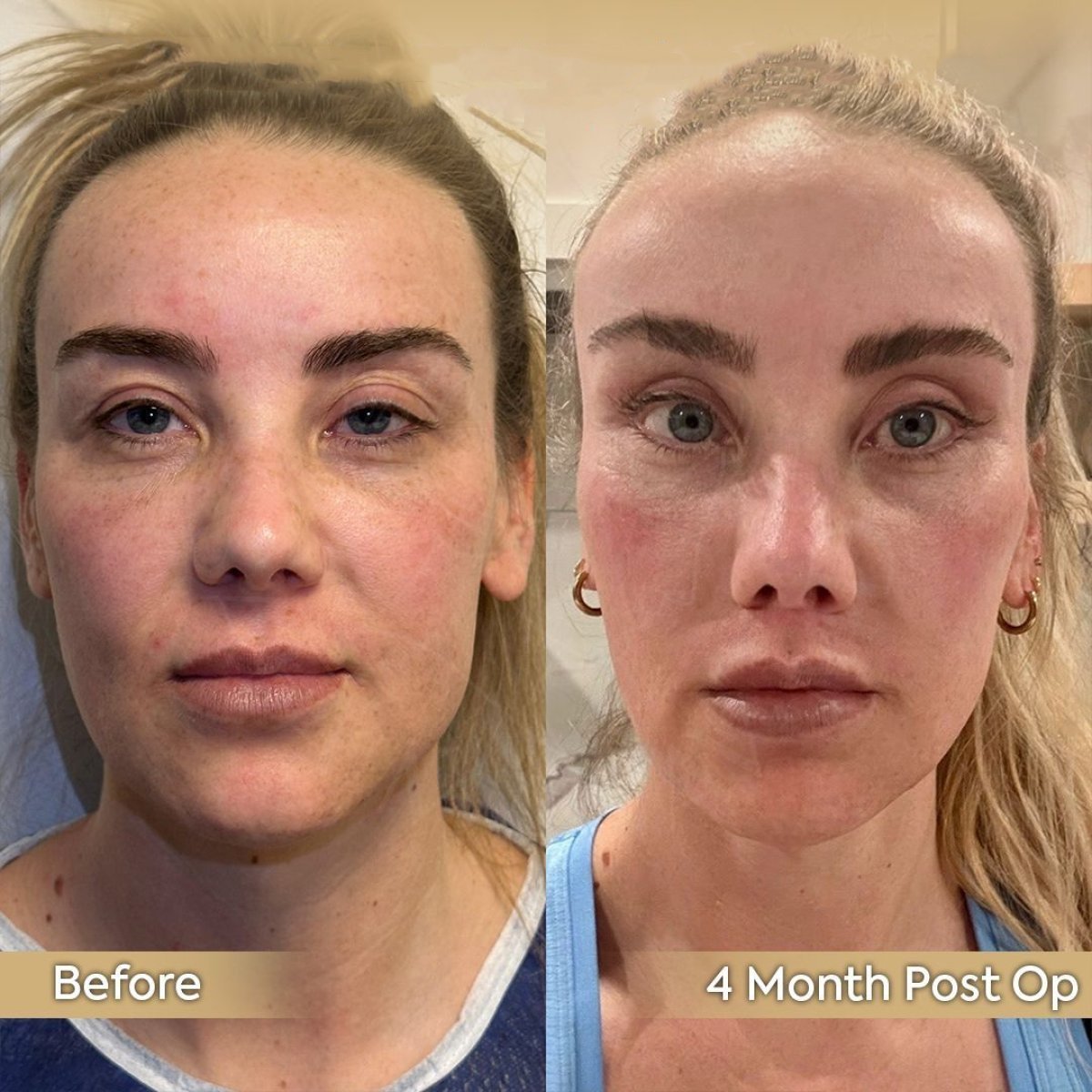 Resultados de extracción de grasa bucal antes y después en Dr. Safa Manav Clinic, rostro más delgado