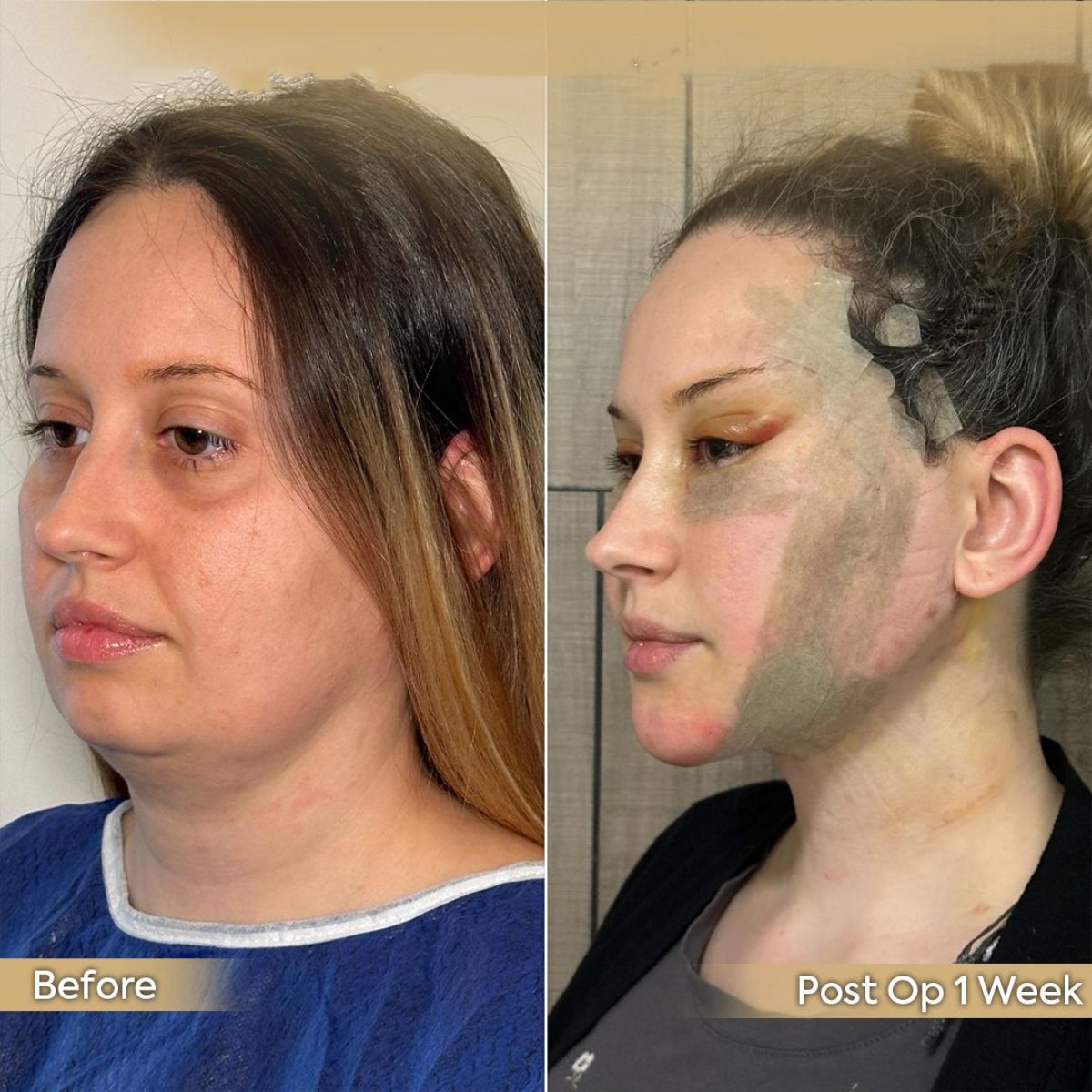 Resultados antes y después de extracción de grasa bucal en Dr. Safa Manav Clinic, rostro más delgado