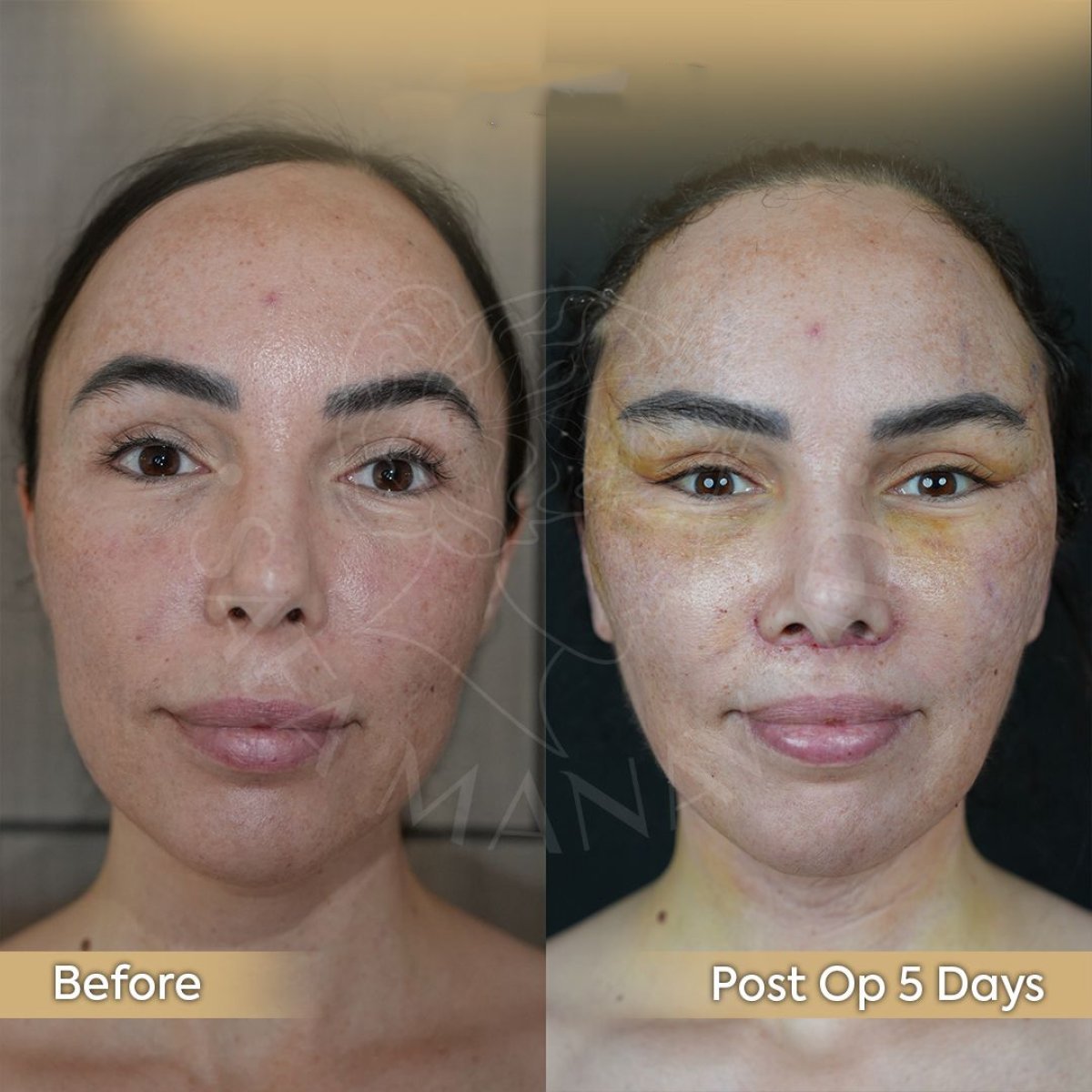 Antes y después de extracción de grasa bucal en Dr. Safa Manav Clinic, resultado a 5 días