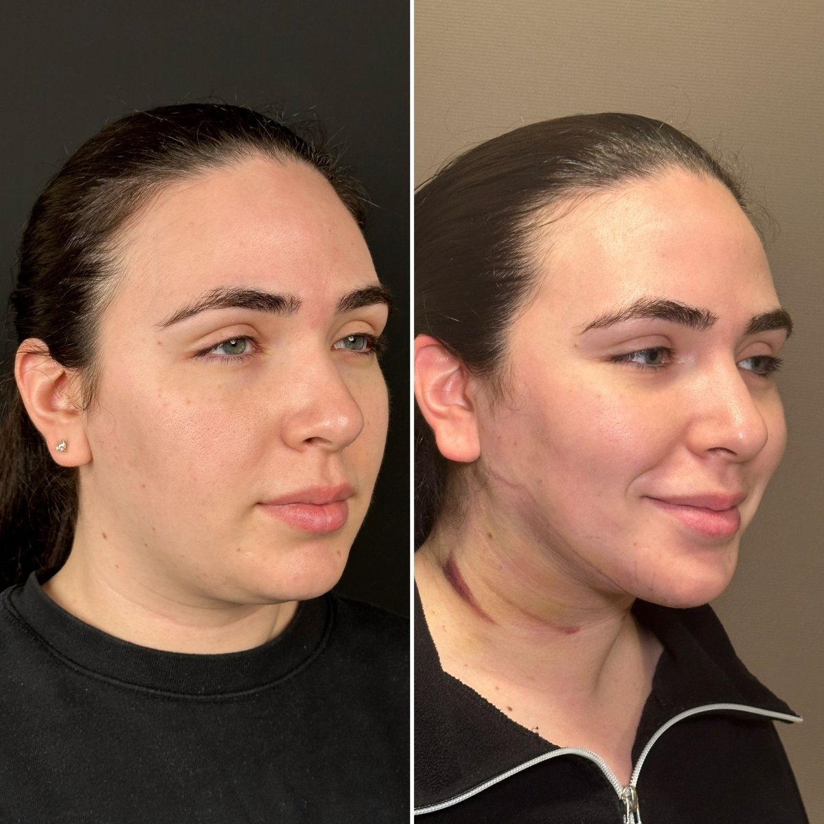 Antes y después de extracción de grasa bucal en Dr. Safa Manav Clinic, rostro más definido