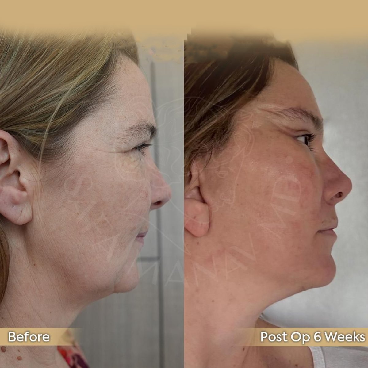 Resultados de lifting de cuello antes y después en Dr. Safa Manav Clinic, mejora visible de la mandíbula