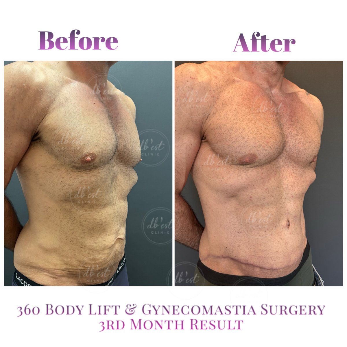 Before and after 360 body lift and gynecomastia surgery results at Db'est Clinic