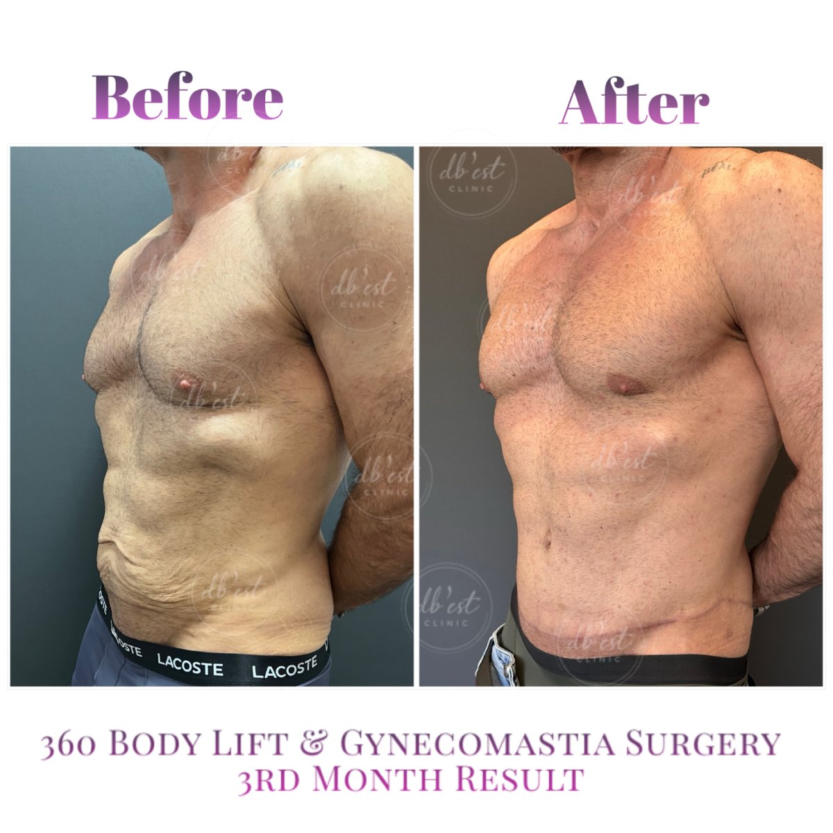 Before and after 360 body lift and gynecomastia surgery results at Db'est Clinic, 3 months