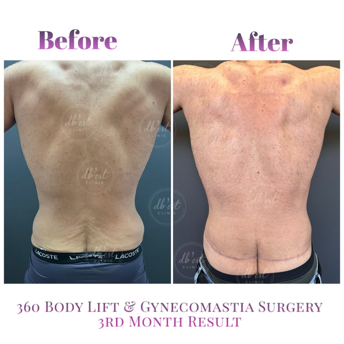Before and after 360 body lift and gynecomastia surgery result at Db'est Clinic, 3 months