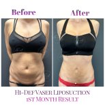 Before and after Liposuction photos by Dr. Derya Bingol