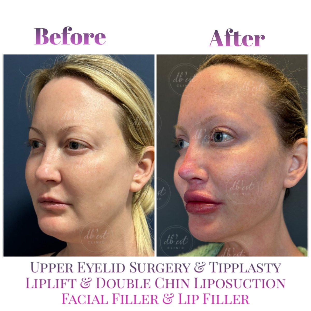 Vorher-nachher-Ergebnis von Lip Lift und Gesichtsfiller bei Db'est Clinic, vollere Lippen