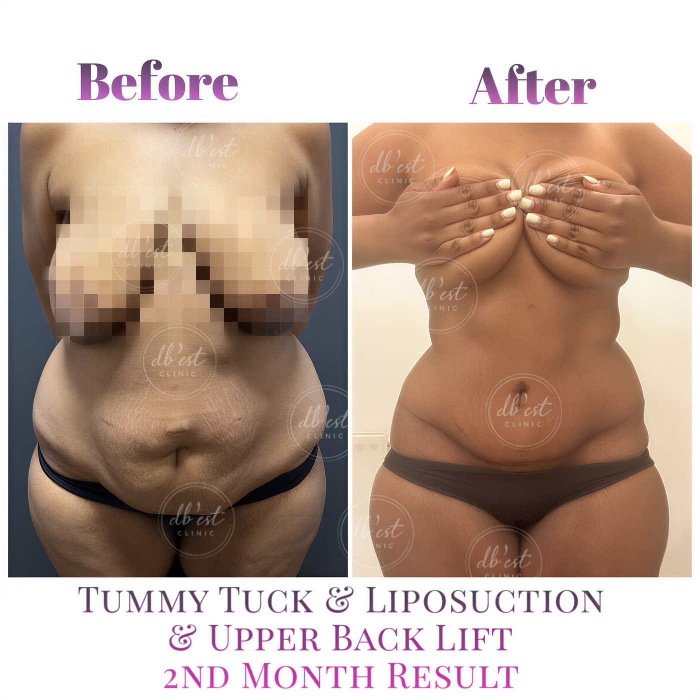 Resultados de abdominoplastia, liposucción y lifting de espalda en Db'est Clinic, 2 meses