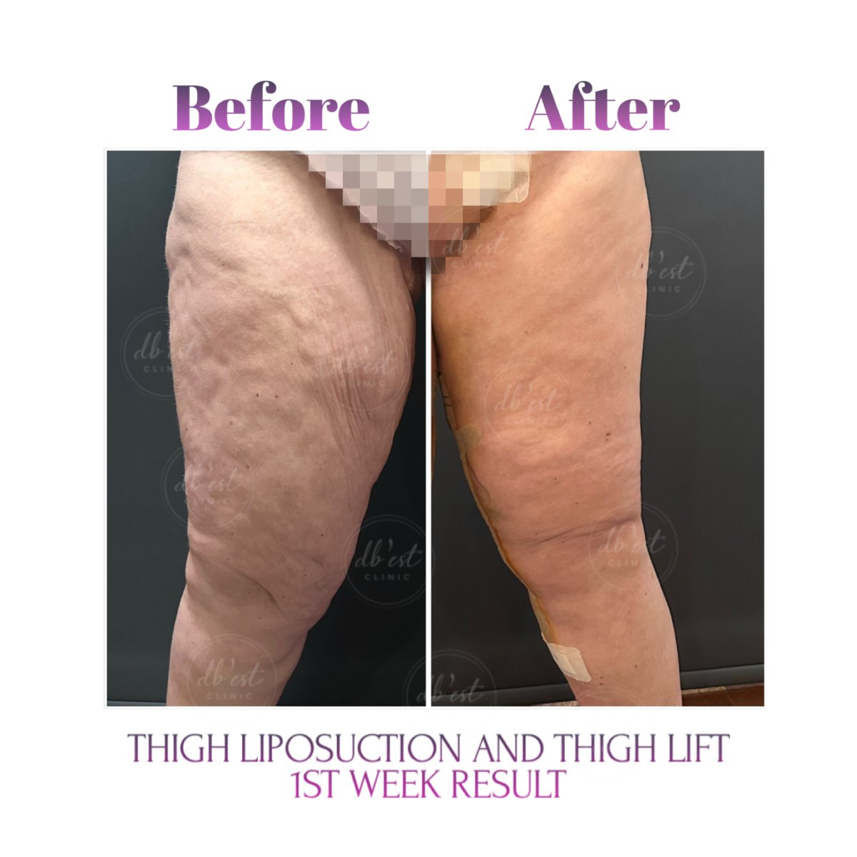 Before and after thigh lift and liposuction results at Db'est Clinic, 1st week post-op