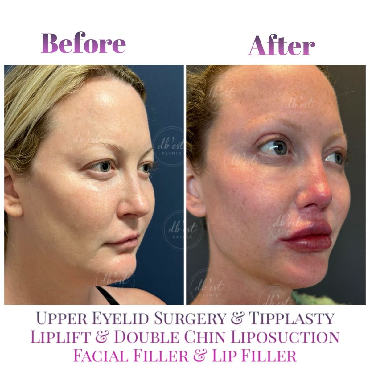 Resultados antes y después de rejuvenecimiento facial en Db'est Clinic: párpados, tipplastia, rellenos