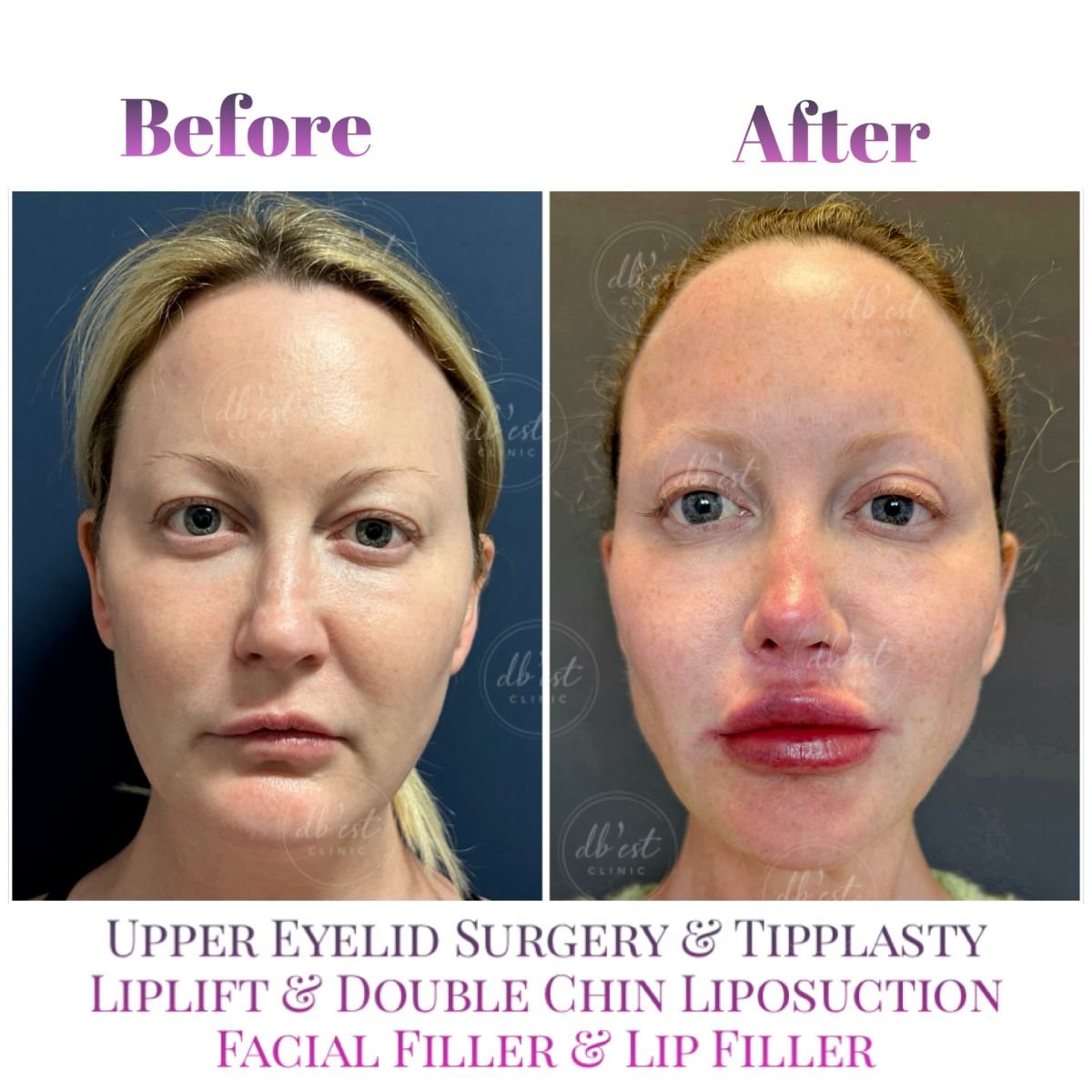 Resultados antes y después de rejuvenecimiento facial en Db'est Clinic: párpados, liplift, rellenos