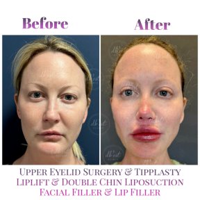 Premium Rhinoplasty with Double Board Certified Surgeon - photo 3