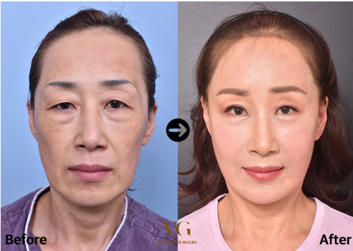 نتائج عملية شد الجفون العلوية والسفلية في VG Plastic Surgery، عيون أكثر شباباً