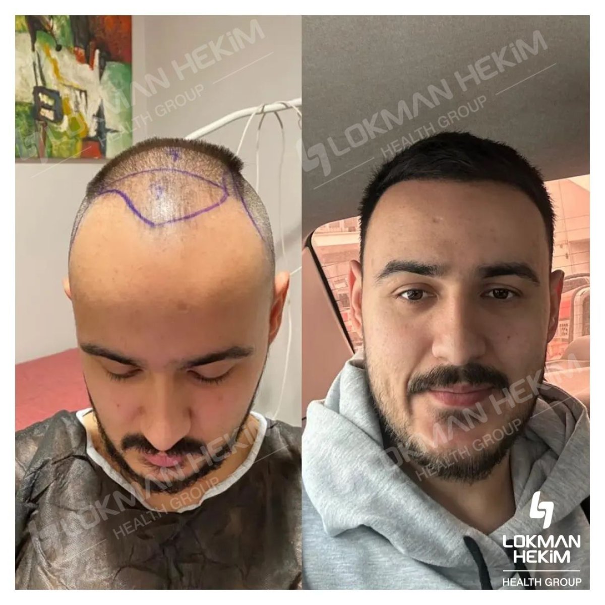 Before and after FUE hair transplant results at Lokman Hekim Istanbul Hospital, restored hairline
