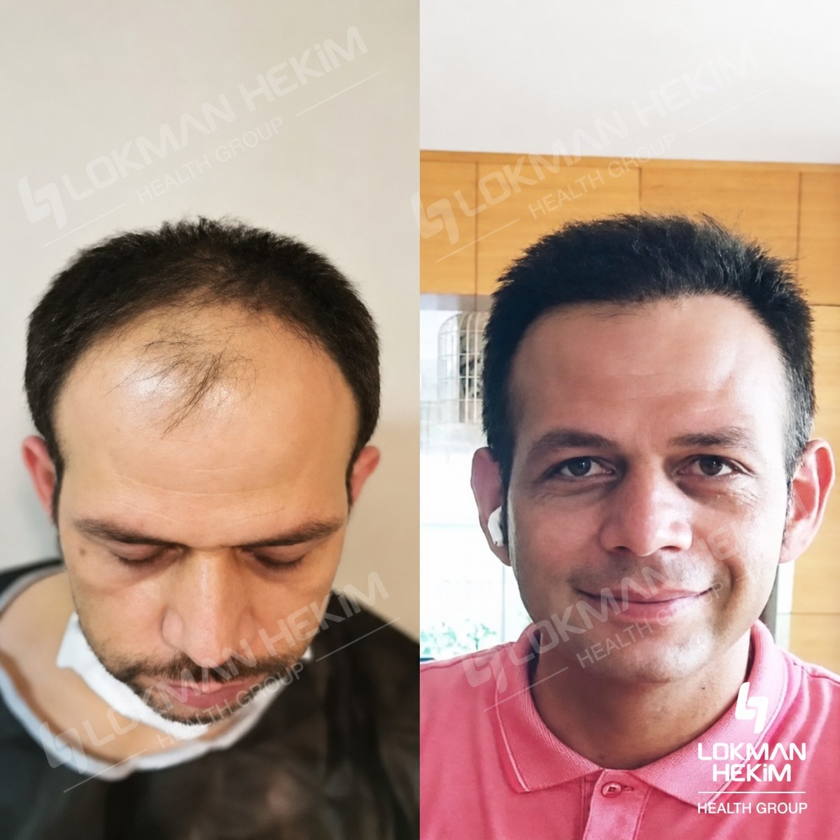 Before and after FUE hair transplant results at Lokman Hekim Istanbul Hospital, fuller hairline