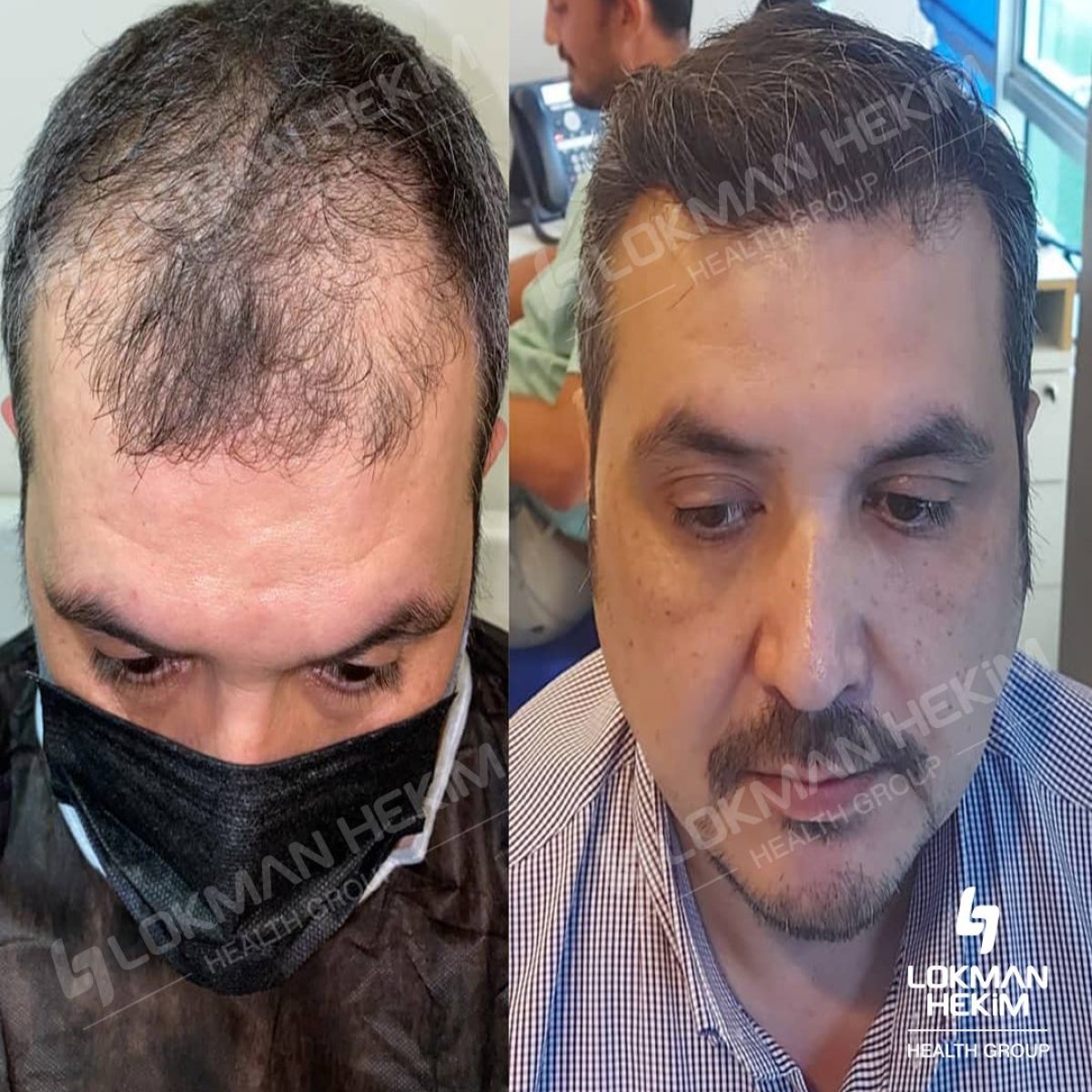 Resultados antes y después de trasplante capilar FUE en Lokman Hekim Istanbul Hospital, línea capilar más densa