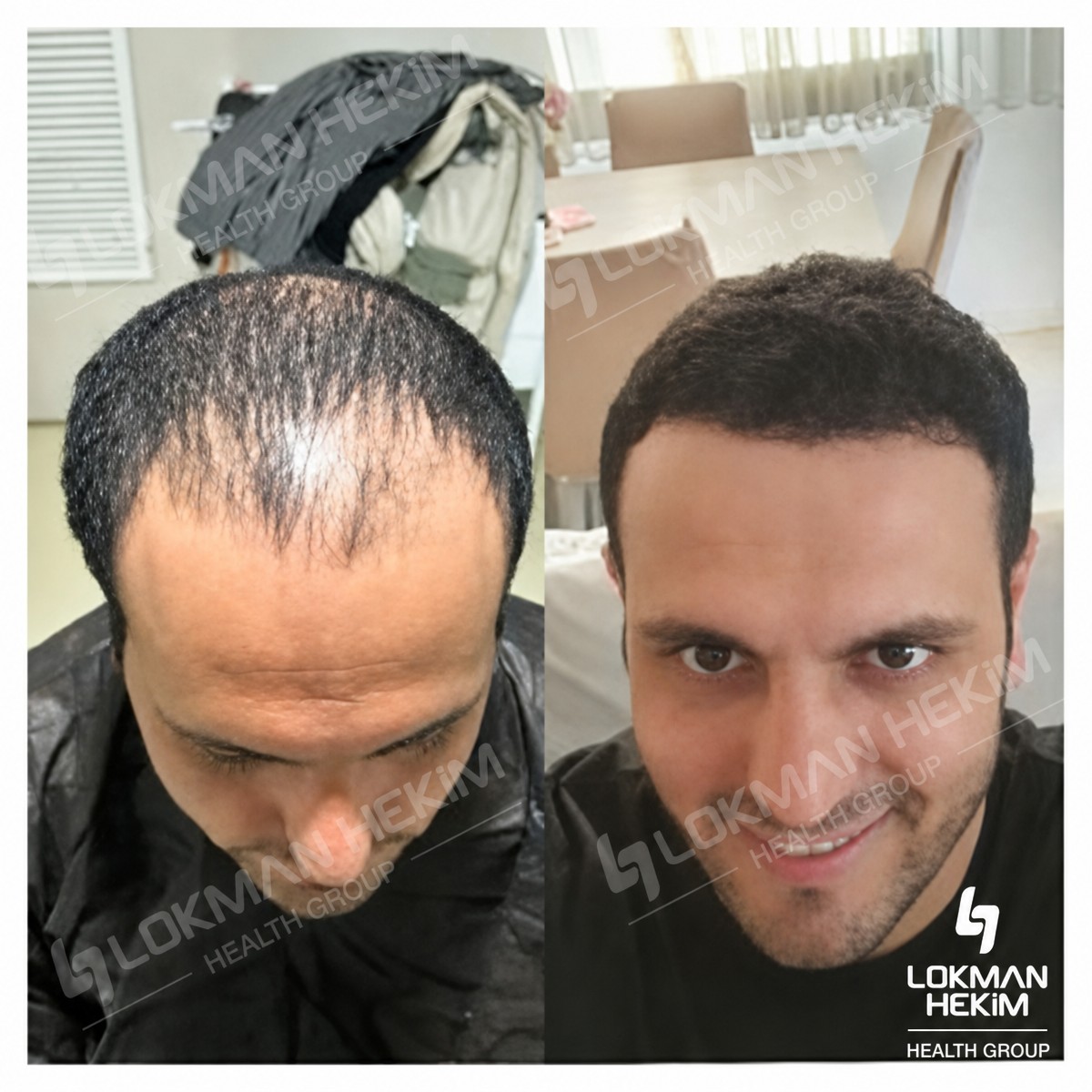 Resultados antes y después de trasplante capilar FUE en Lokman Hekim Istanbul Hospital, línea capilar más densa