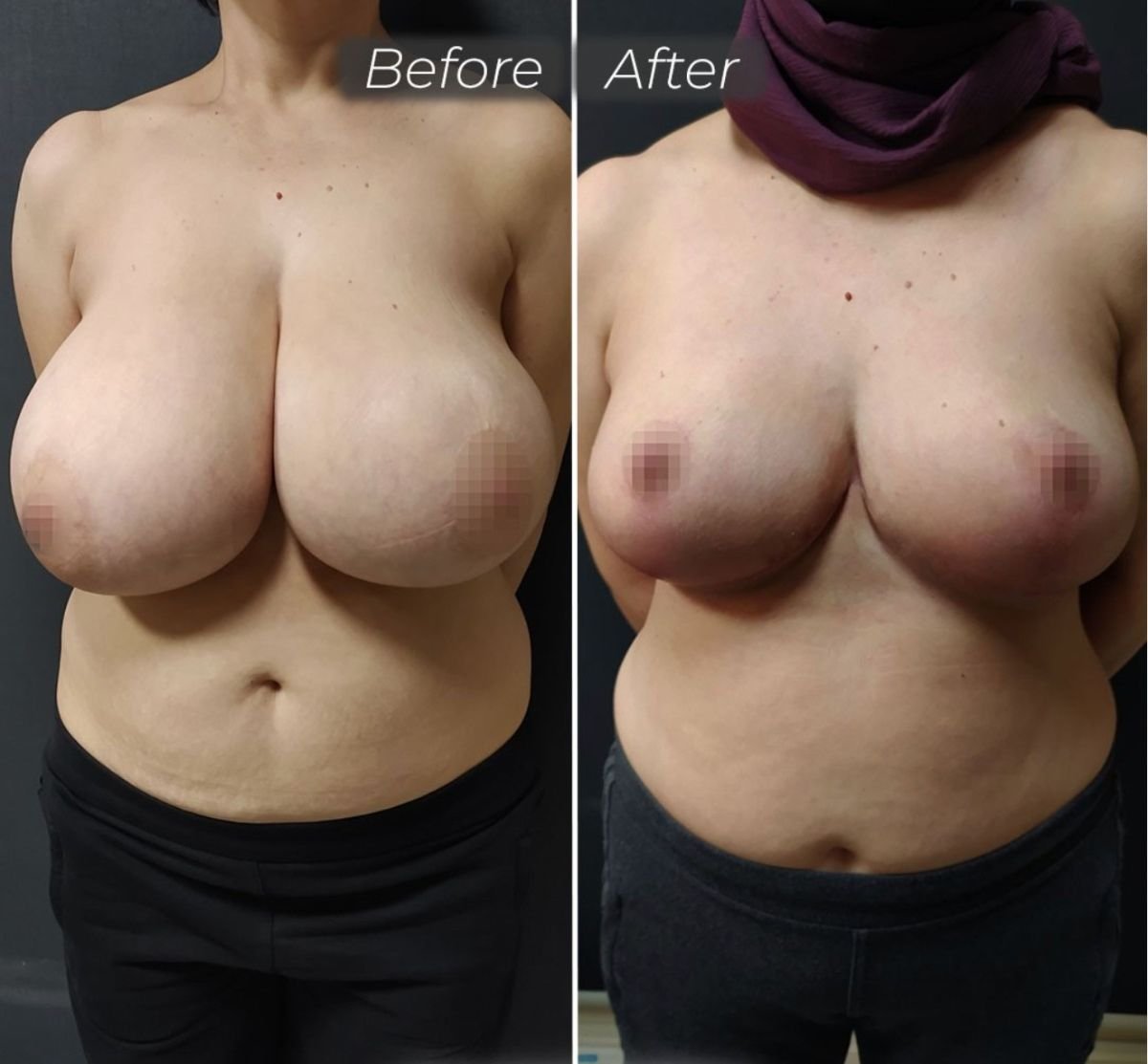 نتائج تصغير الثدي قبل وبعد في عيادة Dr. Safa Manav، تقليل الحجم بشكل واضح
