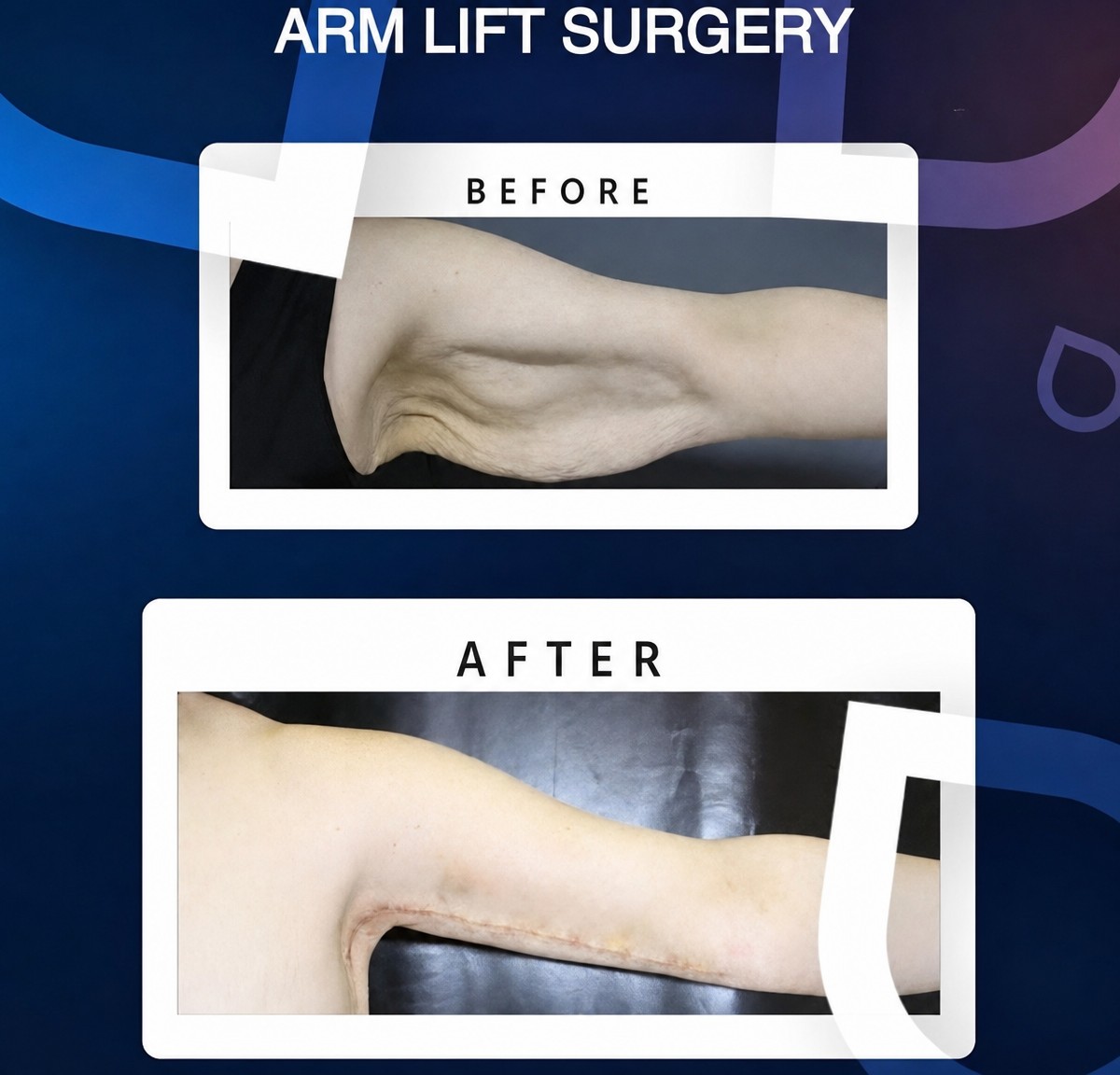 Before and after arm lift (brachioplasty) results at TWT Health Clinic, improved arm contour
