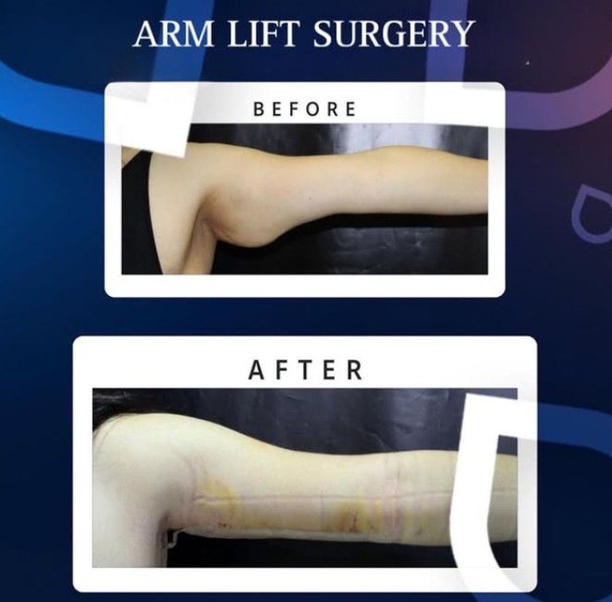 Resultados de lifting de brazos (braquioplastia) antes y después en TWT Health Clinic