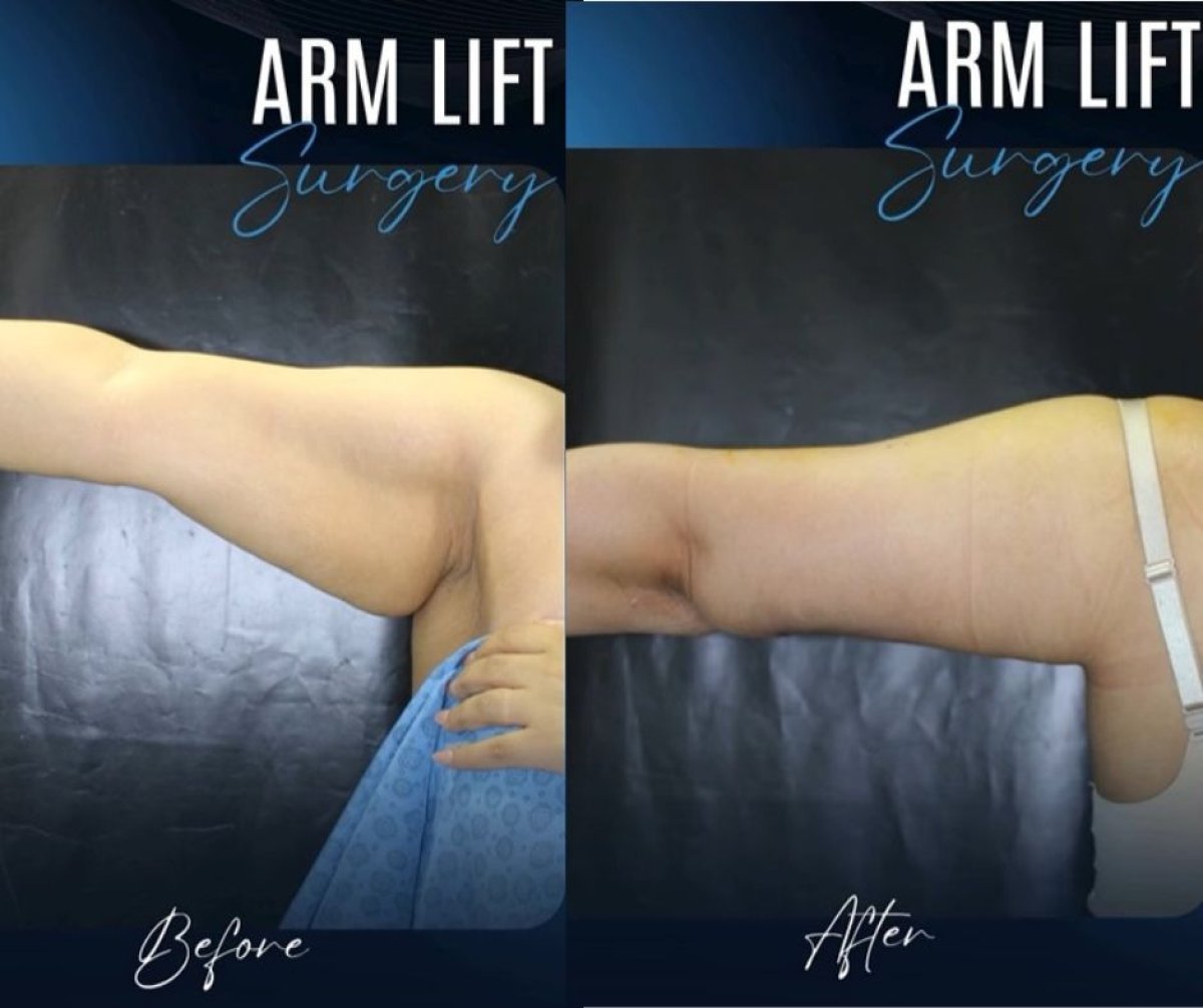 Before and after arm lift (brachioplasty) results at TWT Health Clinic, improved arm contour