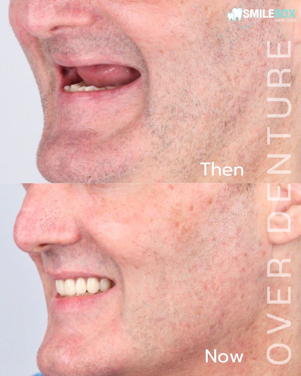 Before and after All-on-4 dental implants result at SmileBox Dental Clinic - Thonglor branch