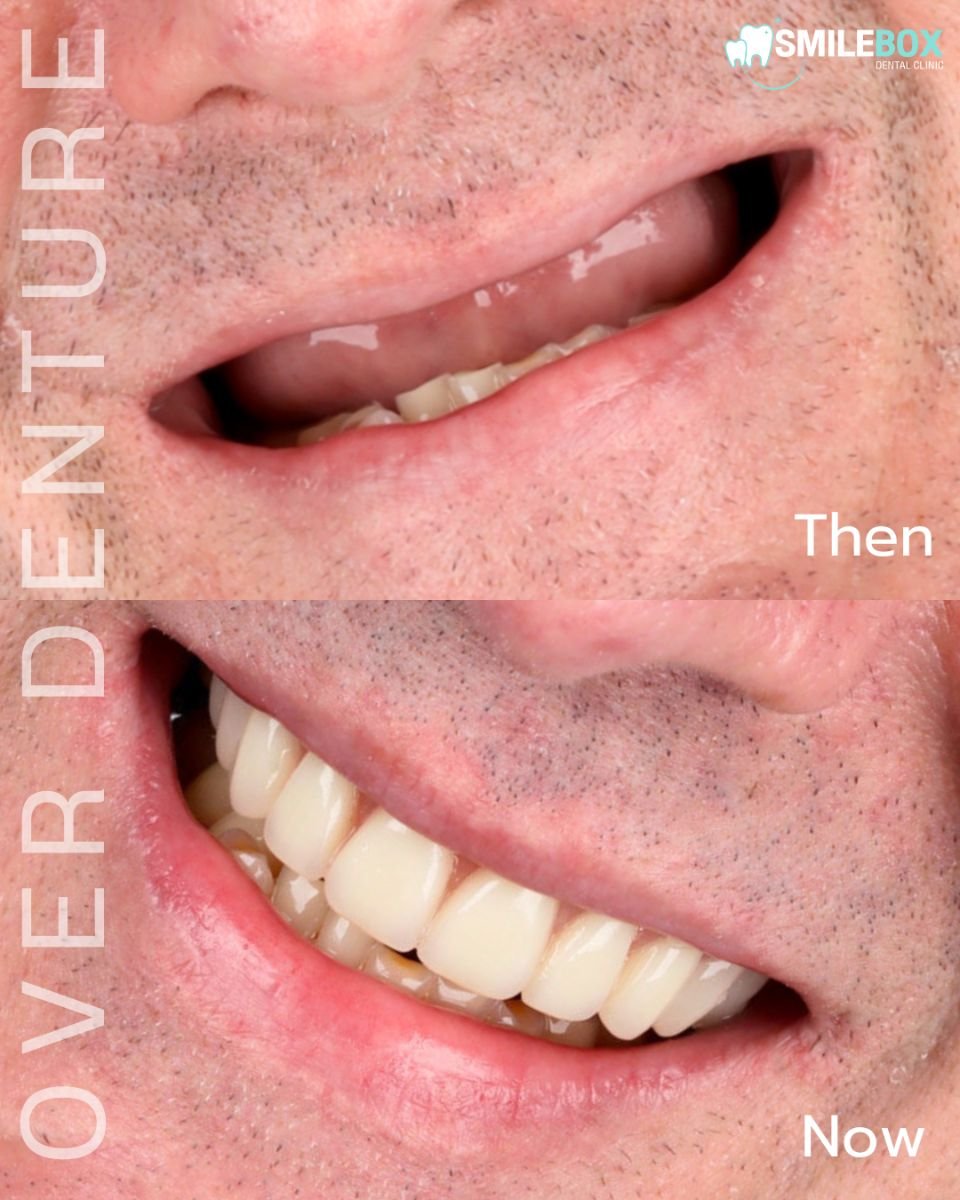 Resultados antes y después de implantes All-on-4 en SmileBox Dental Clinic - sucursal Thonglor