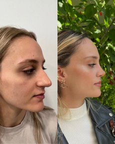 Standard Rhinoplasty (nose job) - photo 6
