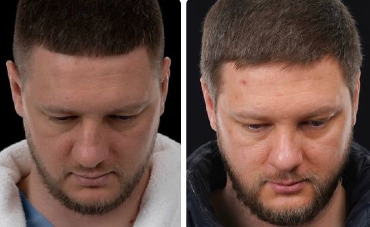 قبل وبعد زراعة الشعر FUE في Yurchenko Plastic Surgery Team، نتيجة كثافة الشعر