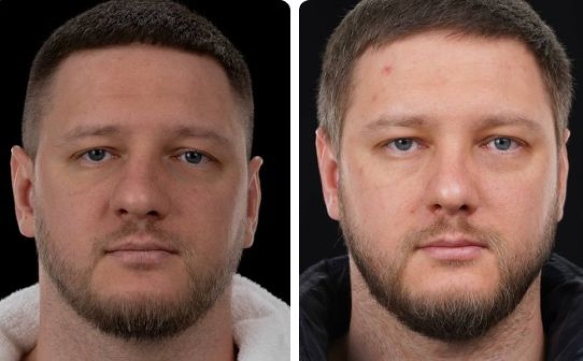نتائج عملية تجميل الأنف قبل وبعد في Yurchenko Plastic Surgery Team، تحسين شكل الأنف