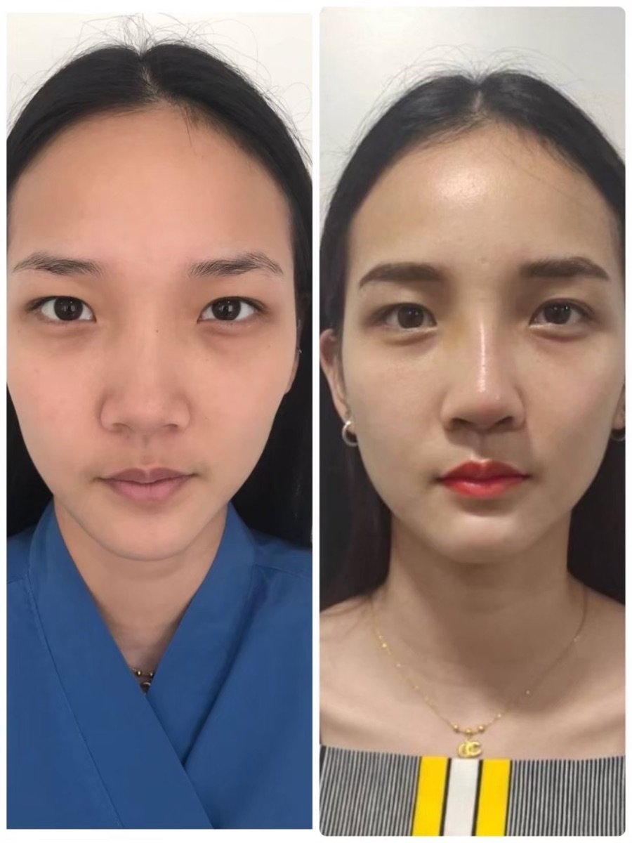 Before and after revision rhinoplasty result at ID Clinic Bangkok, improved nose shape