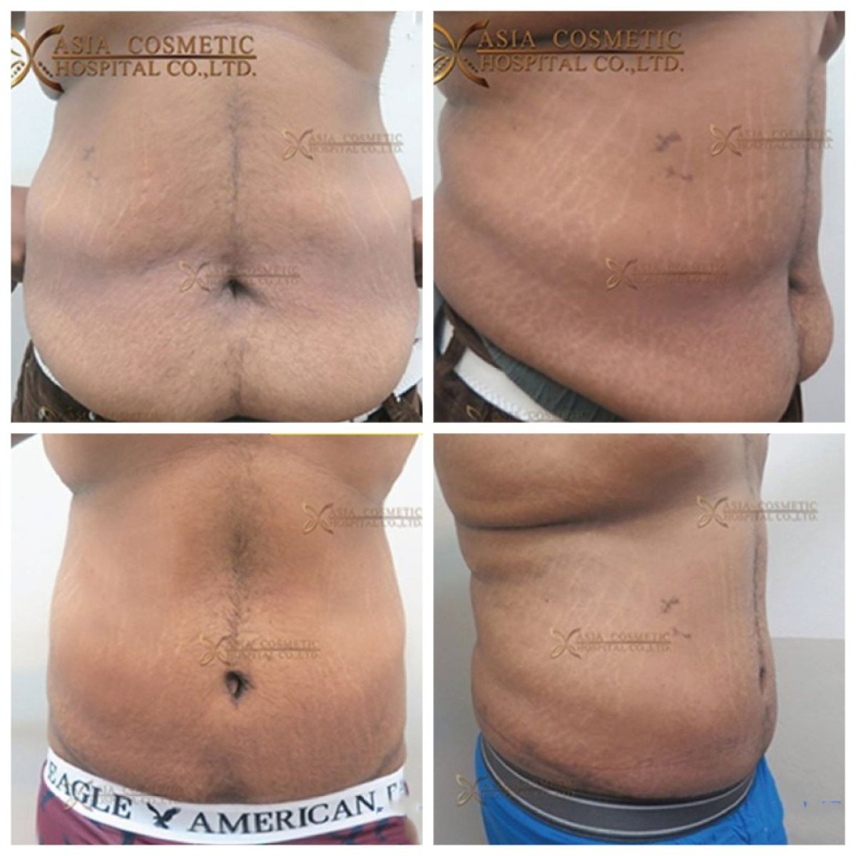 Before and after liposuction results at Asia Cosmetic Hospital, visible abdominal fat reduction