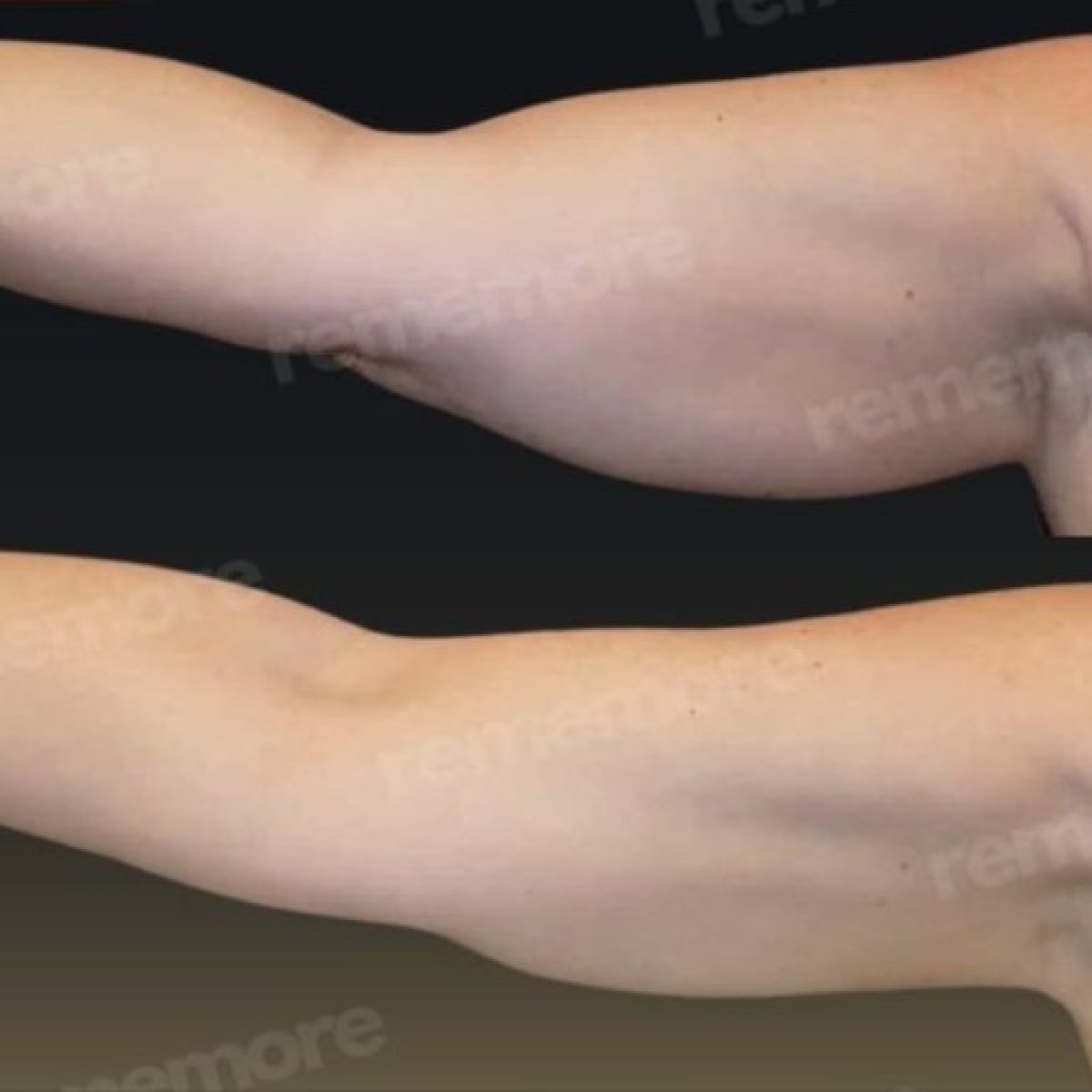 Before and after arm lift results at Memorial Bahçelievler Hospital, brachioplasty procedure