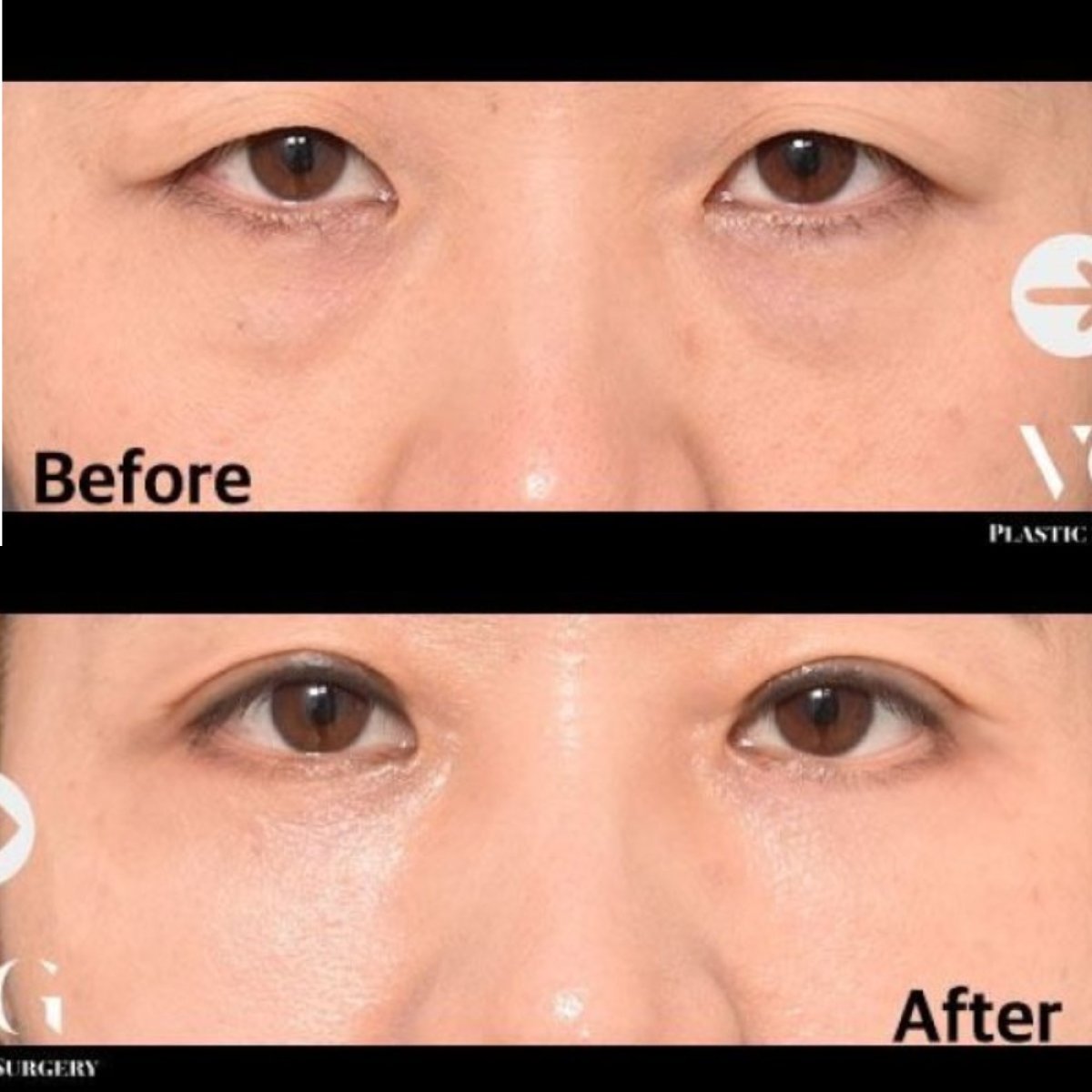 Résultats avant/après de la chirurgie des paupières supérieures et inférieures chez VG Plastic Surgery