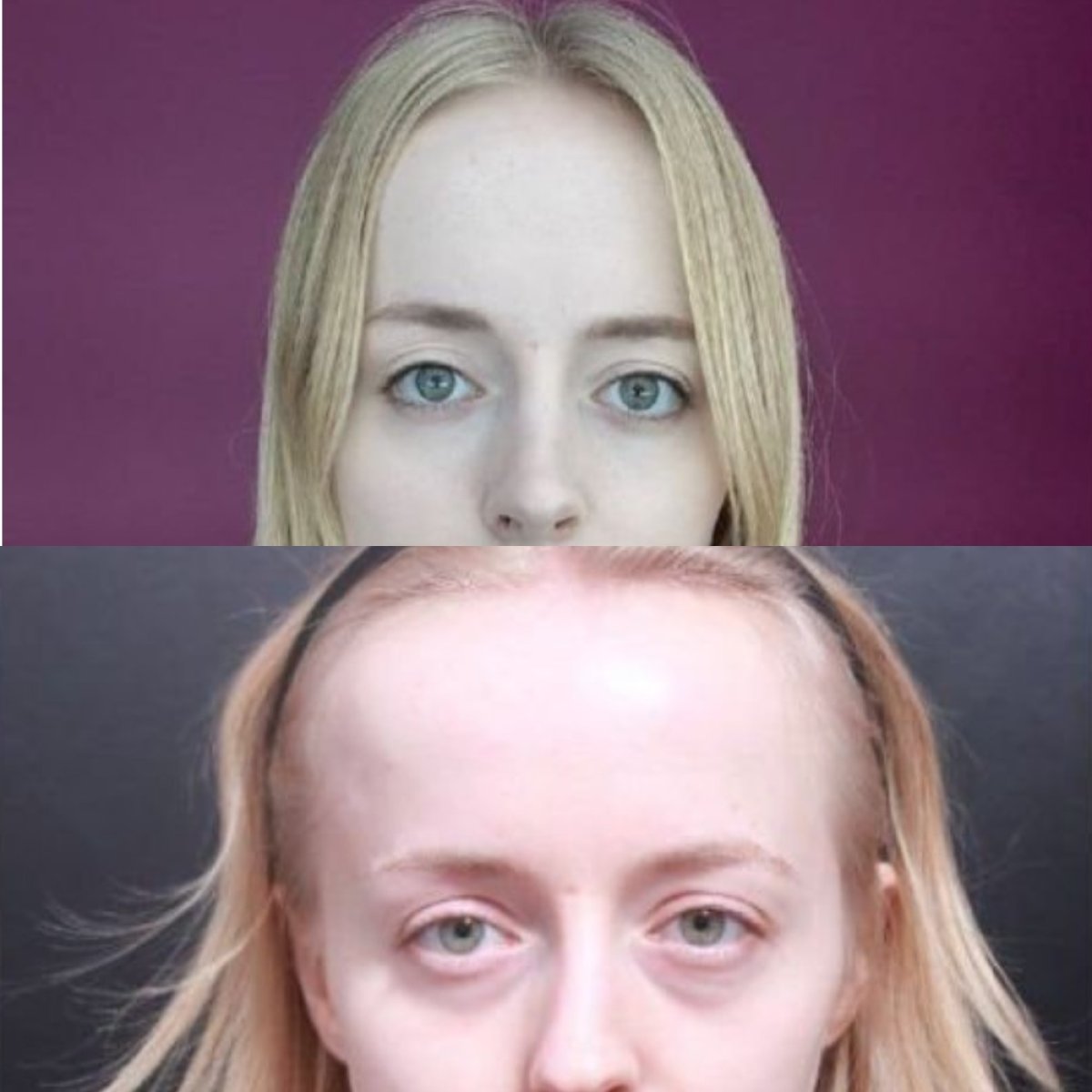 نتائج جراحة الجفون العلوية والسفلية قبل وبعد في عيادة VG Plastic Surgery