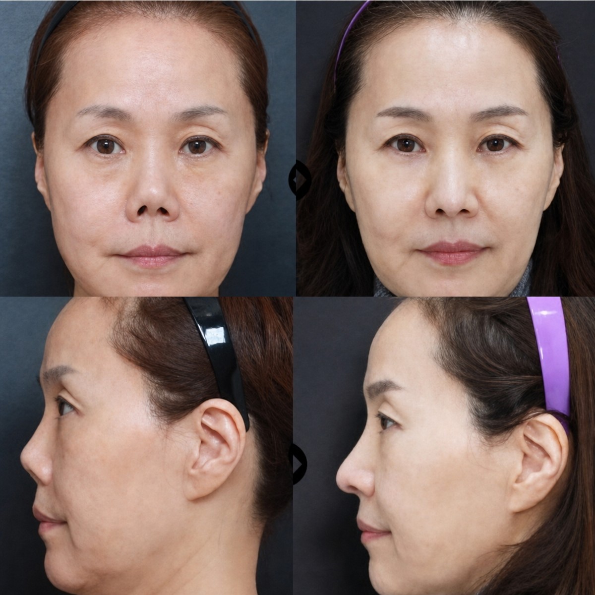 نتائج قبل وبعد عملية تجميل الأنف التصحيحية في VG Plastic Surgery، تحسين شكل الأنف