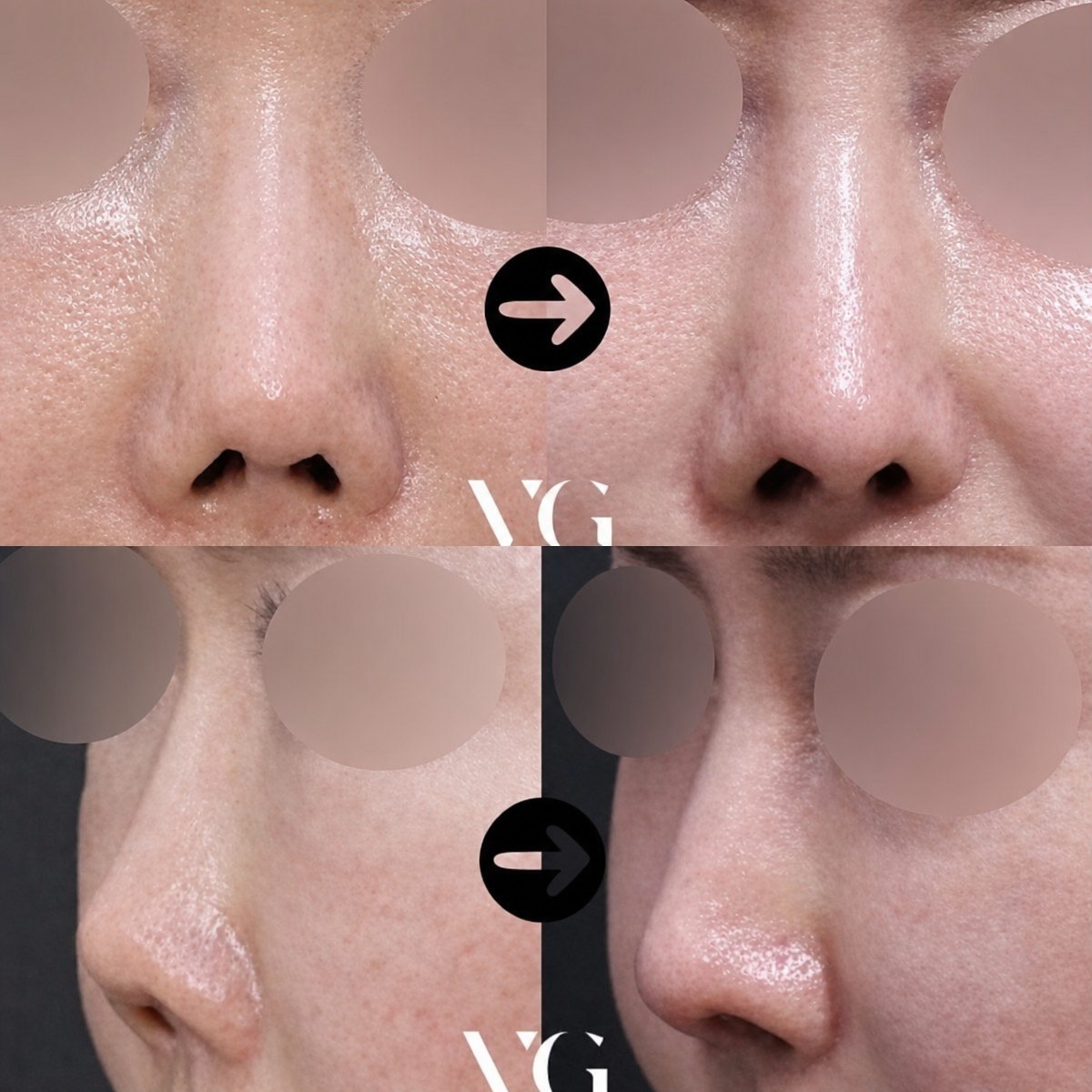 Результати до і після ревізійної ринопластики у VG Plastic Surgery, покращена форма носа