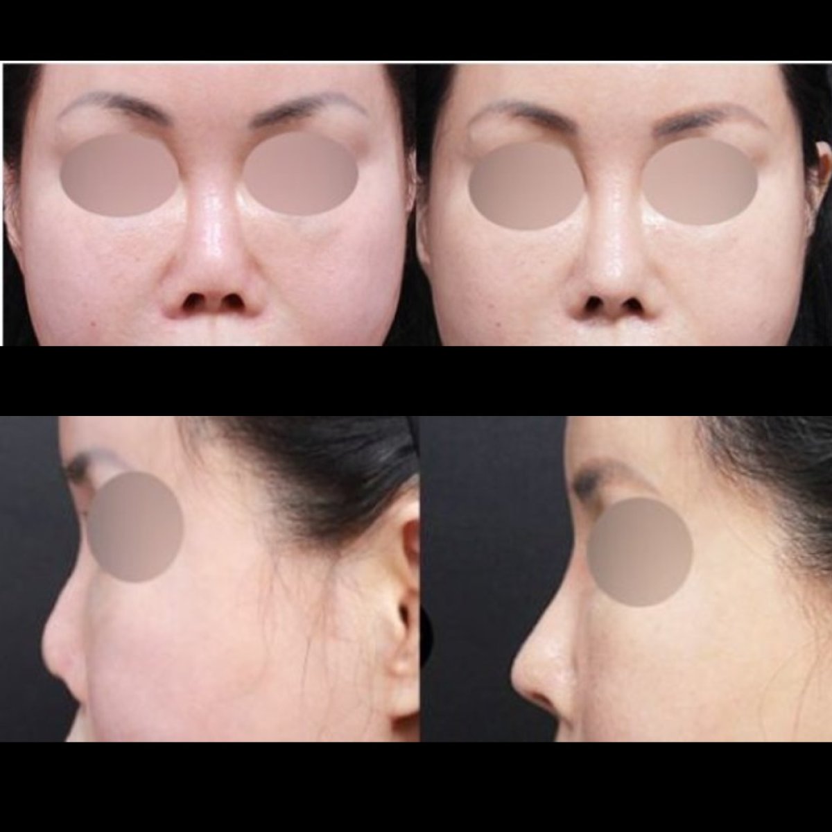نتائج قبل وبعد عملية تجميل الأنف التصحيحية في VG Plastic Surgery، تحسين شكل الأنف