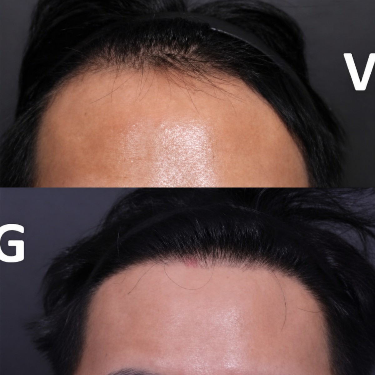 Before and after hair transplant results at VG Plastic Surgery – restored hairline in male patient