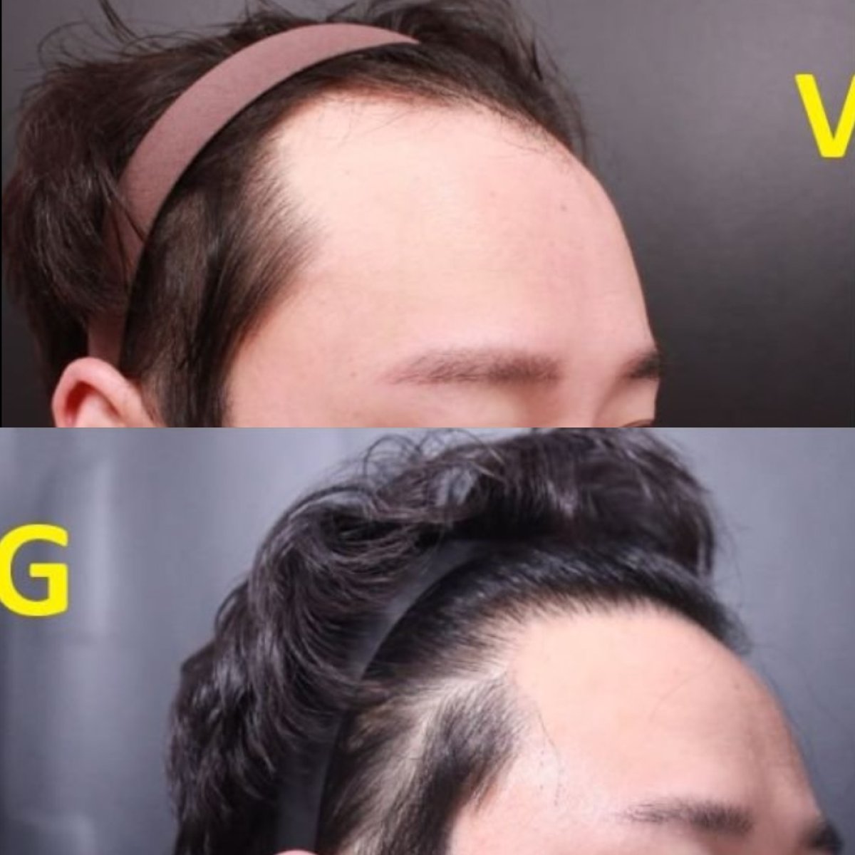 نتائج زراعة الشعر قبل وبعد في VG Plastic Surgery، استعادة خط الشعر لمريض ذكر
