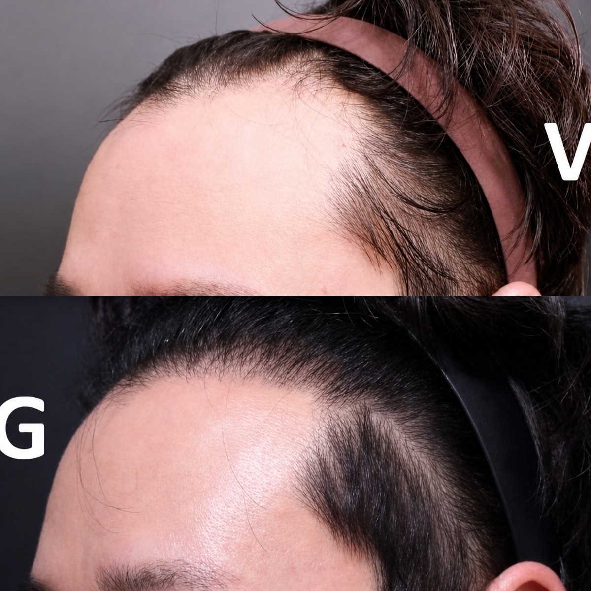Before and after hair transplant result at VG Plastic Surgery – restored hairline in male patient