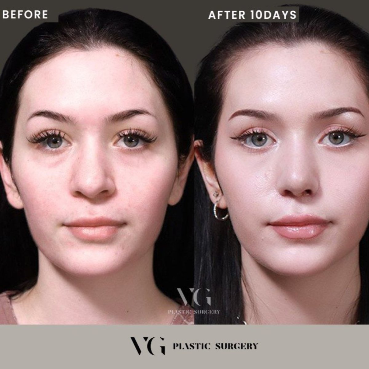 نتائج جراحة تأنيث الوجه قبل وبعد في VG Plastic Surgery بعد 10 أيام من العملية