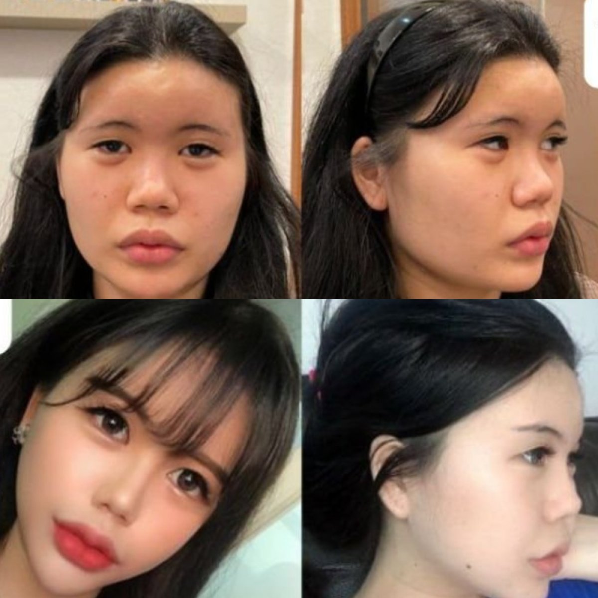 Resultados de cirugía de feminización facial antes y después en VG Plastic Surgery, contornos mejorados