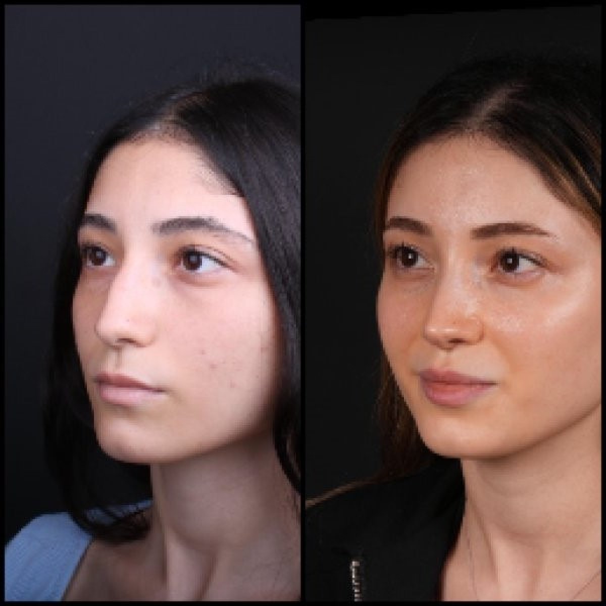 Resultados de rinoplastia antes y después en Medipol Acibadem District Hospital, remodelación nasal