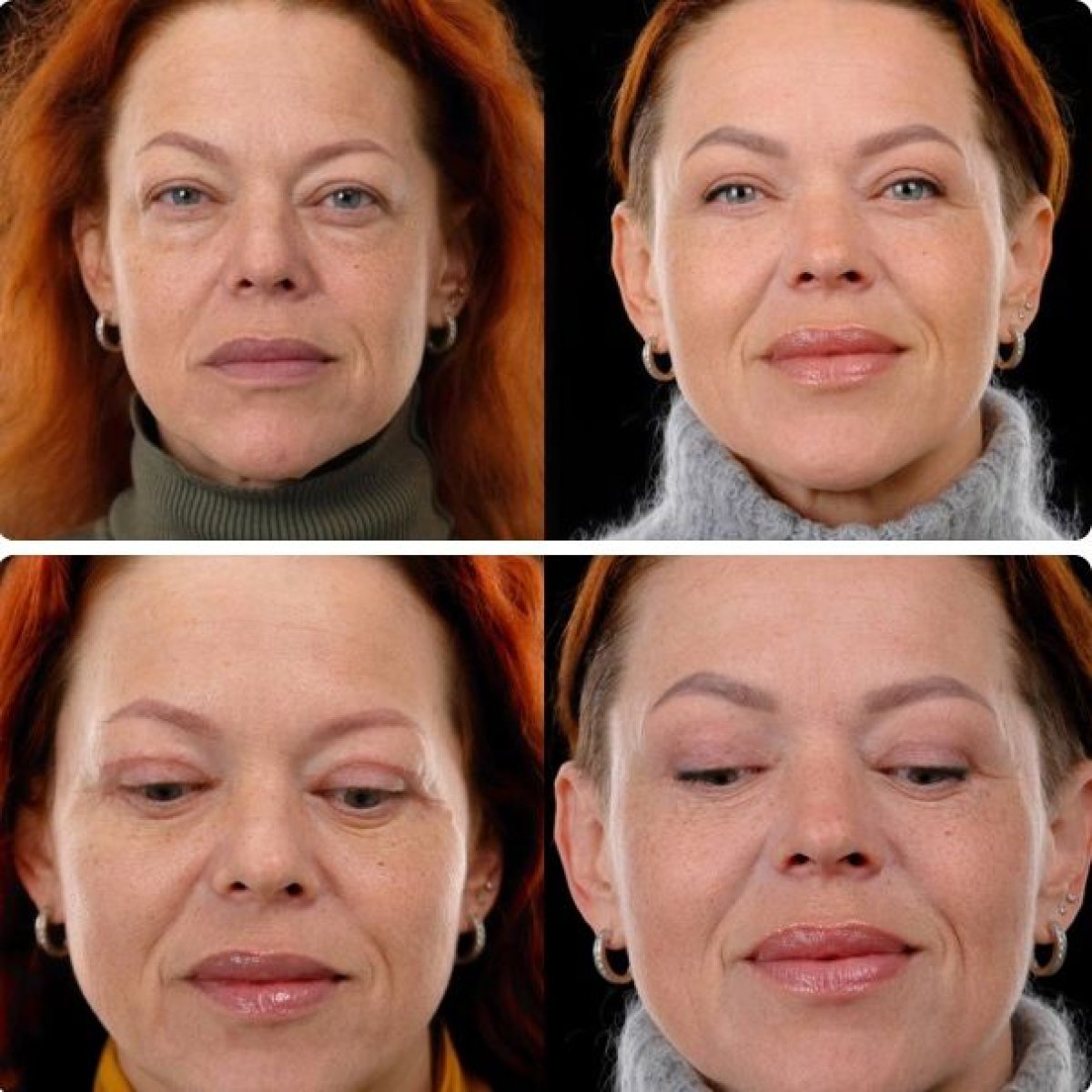 Результаты блефаропластики до и после в Yurchenko Plastic Surgery Team Kyiv, коррекция век
