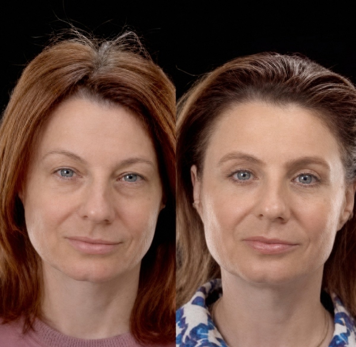 Блефаропластика до та після в Yurchenko Plastic Surgery Team Kyiv, корекція повік