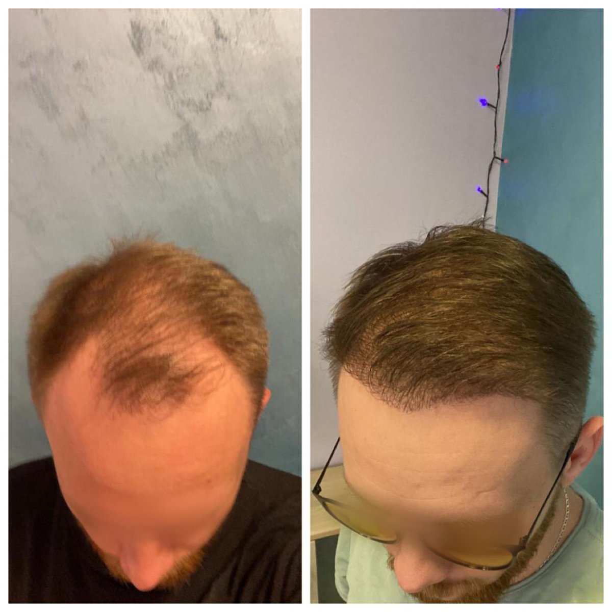 Before and after FUE hair transplant results at Adem and Havva Medical Center, restored hairline