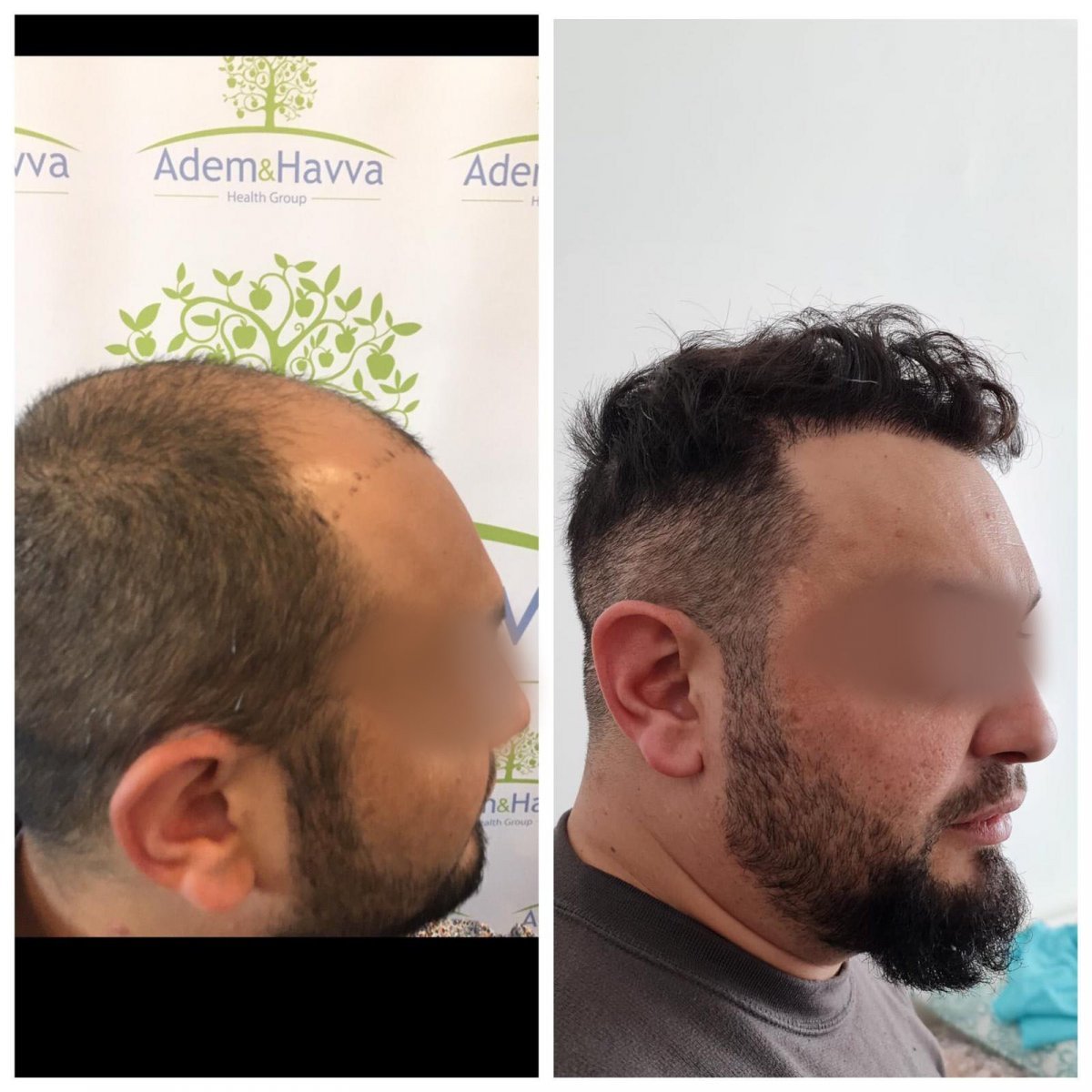 Resultados antes y después de trasplante capilar FUE en Adem and Havva Medical Center, línea más densa